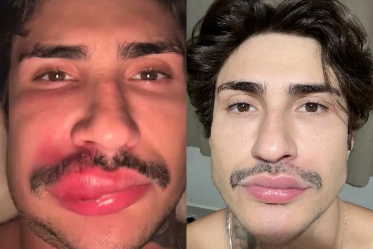Antes e depois: como ficou rosto de influencer 'Ken de CG' após infecção ao espremer espinha